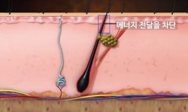 아크네 핸드피스